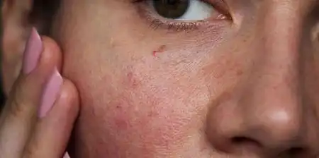 Normal Image